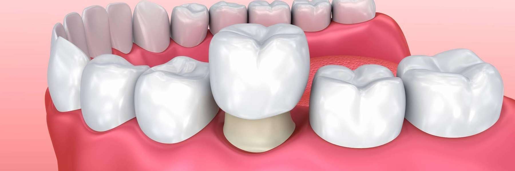 los gatos dental crown