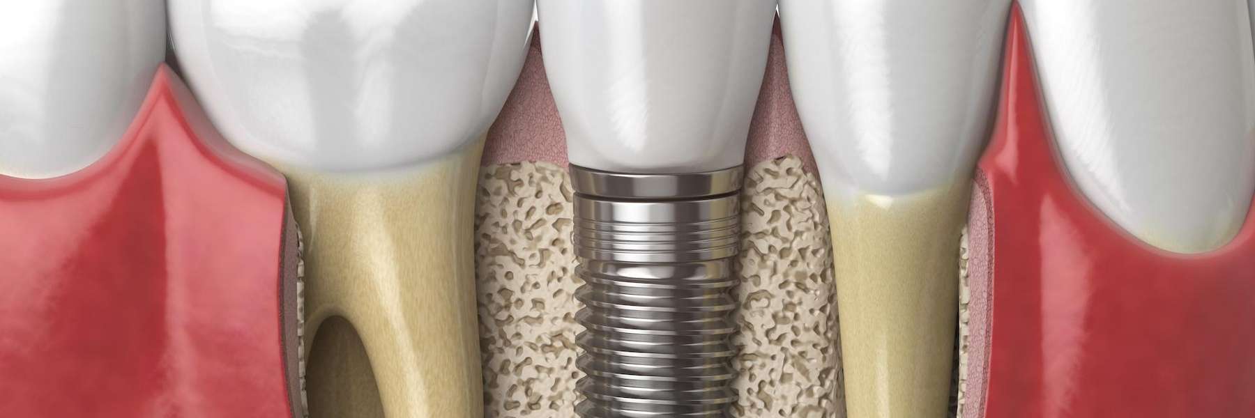 Diagram of dental implant, los gatos ca