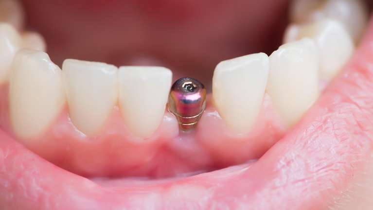 dental implants saratoga