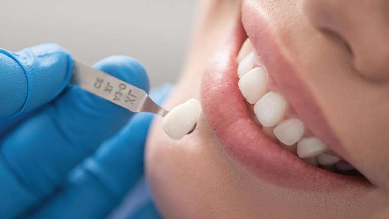 Woman smiling getting fitted for veneers, los gatos ca