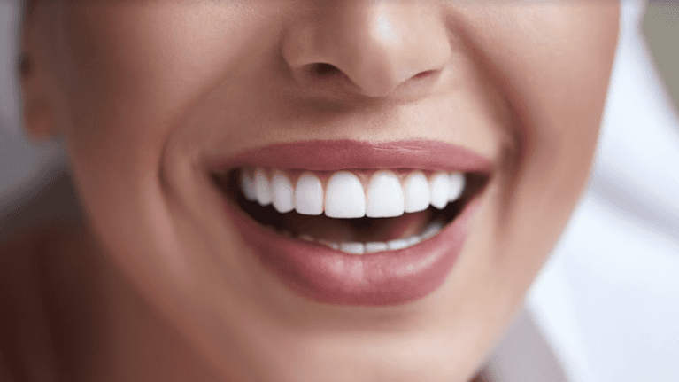 All You Need To Know About Veneers | Los Gatos, CA