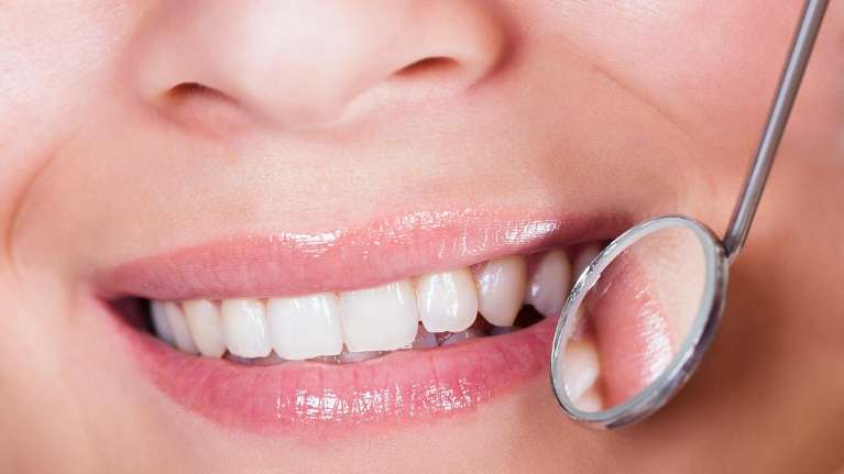 Close up of womans teeth after full smile makeover, los gatos ca