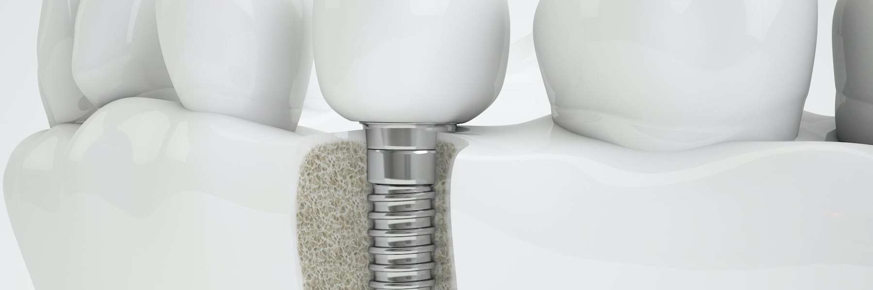 A dental implant with a screw and tooth, highlighting restored smiles and improved oral health.