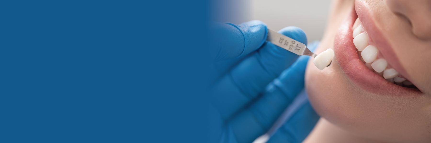 Woman getting veneers | porcelain veneers in los gatos