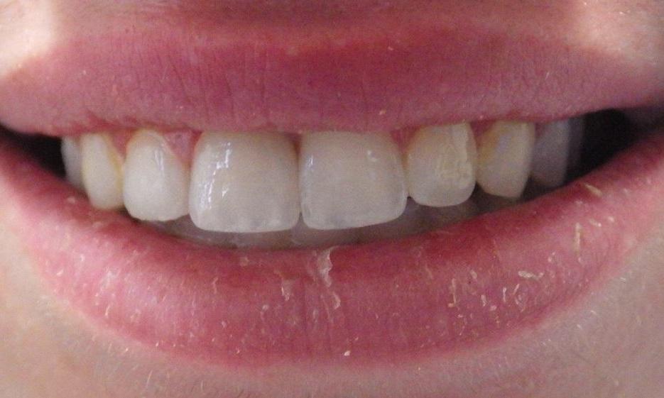 After Smile Enhancement, Lab-Fabricated Crowns