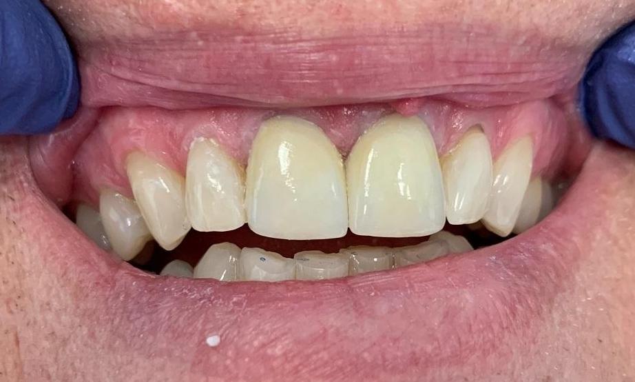 After Smile Enhancement, Lab-Fabricated Porcelain Crowns