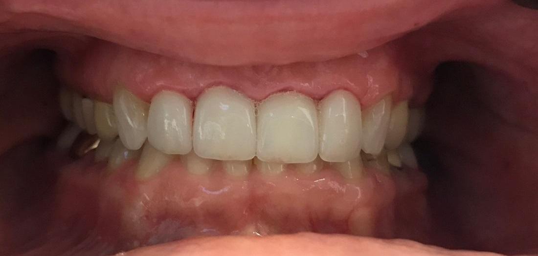 White smile after veneers l Veneers Los Gatos CA