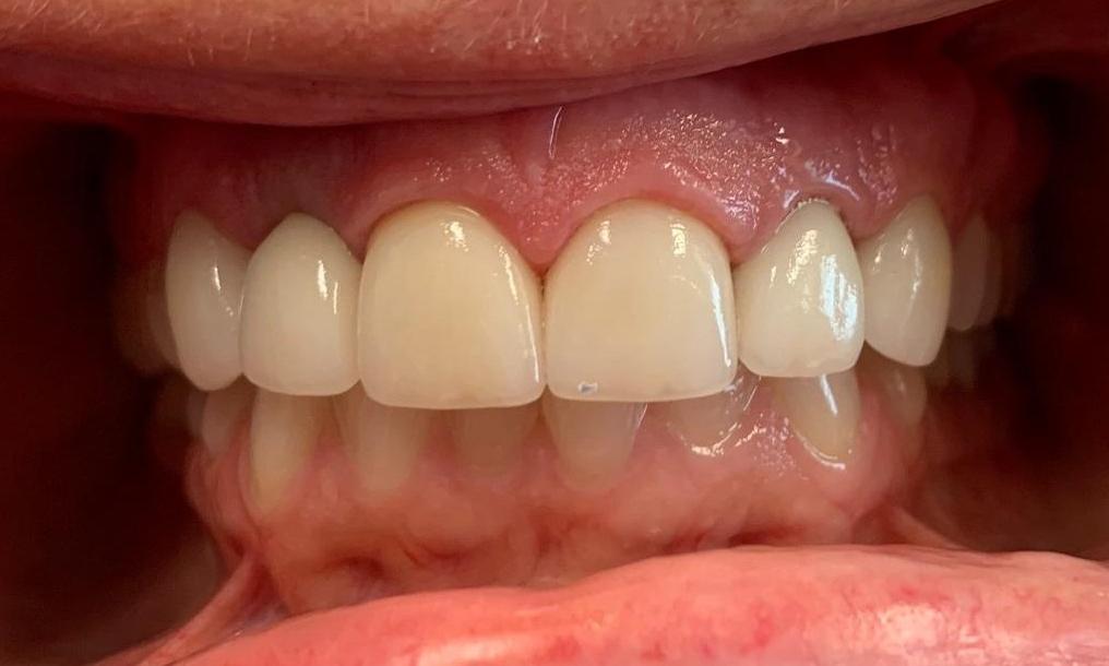 complete smile after dental treatment l veneers in los gatos