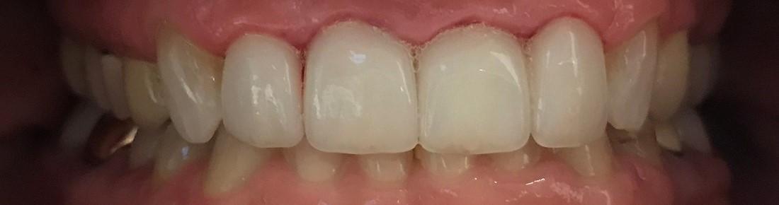 Brilliant smile after veneers l Veneers Los Gatos CA