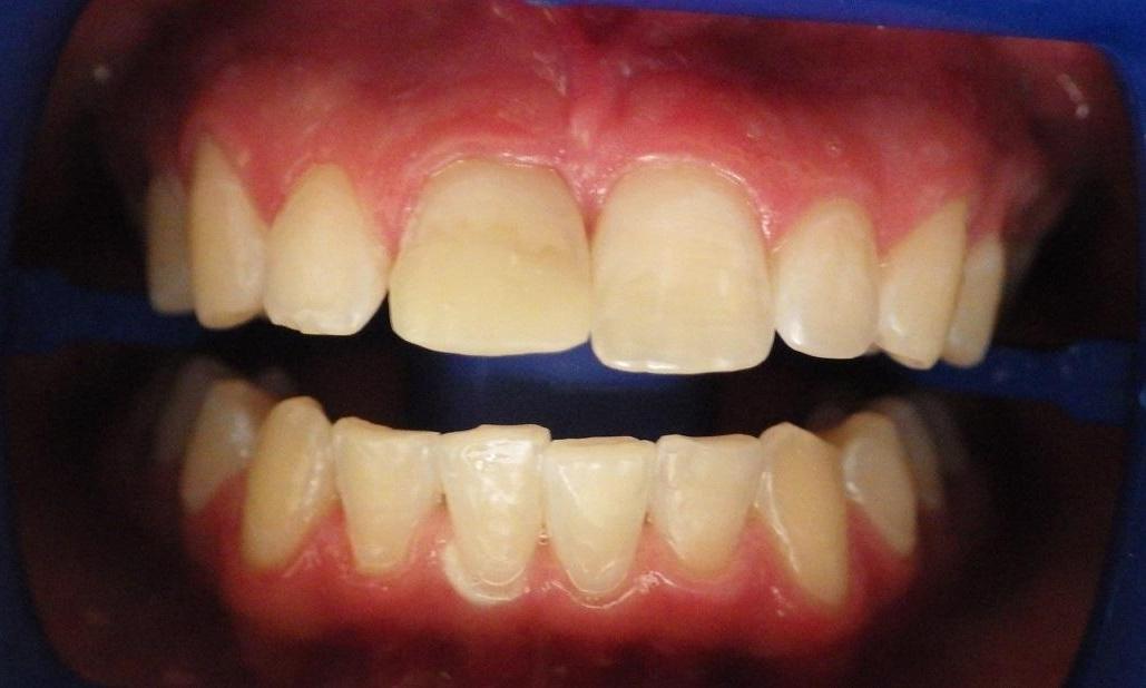 Before Smile Enhancement, Lab-Fabricated Crowns