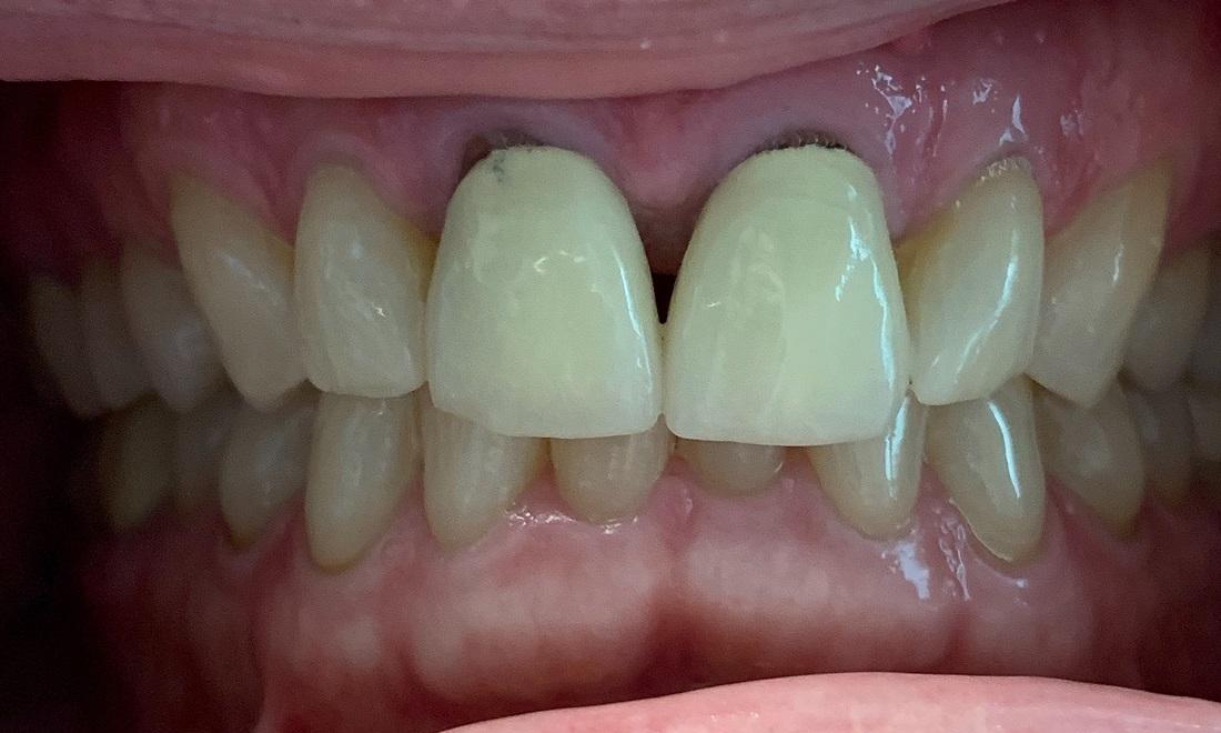 Before Smile Enhancement, Lab-Fabricated Porcelain Crowns