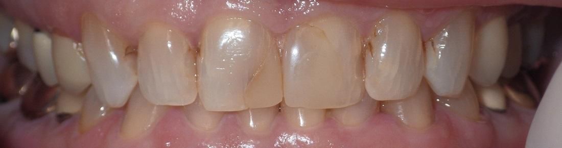 Stained teeth before veneers l Dentist Los Gatos CA