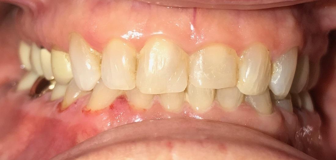 Yellow teeth before veneers l Cosmetic dentist Los Gatos CA