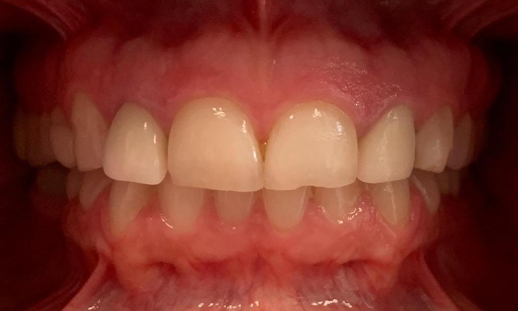 dingy, chipped teeth before veneers l dentist los gatos ca